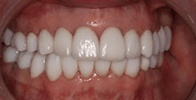 actual patient #5 bright smile after teeth whitening