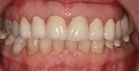 actual patient #5 yellow discolored smile before teeth whitening