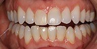 actual patient #8 perfectly aligned teeth with Invisalign