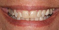 actual patient #9 properly aligned bottom teeth after Invisalign