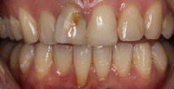 actual patient #13 severe decay on front tooth before veneers