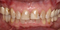 actual patient #14 severely decayed and discolored teeth before dental treatment