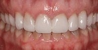 actual patient #2 healthy teeth after gumlift and veneers