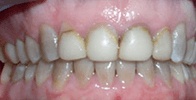 actual patient #2 decayed teeth before gumlift and veneers