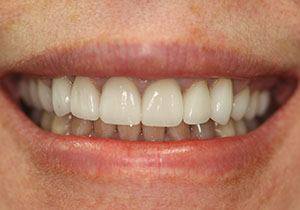 actual patient #2 Closeup of whitened smile after dental treatment