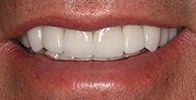 actual patient #6 healthy and bright smile after veneers and crowns