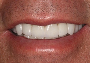 actual patient #6 restored smile through veneers and crowns