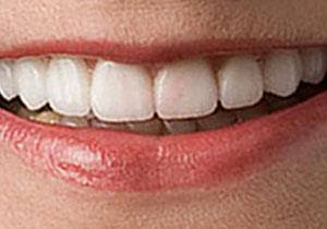 actual patient #3 Closeup of whitened teeth after treatment