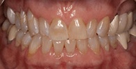 actual patient #4 discolored teeth before dental treatment
