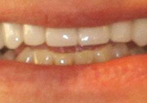 actual patient #4 bright white smile closeup