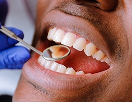 Closeup of smile during dental exam for metal free dental crown
