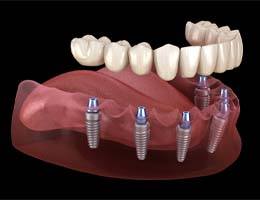 Implant dentures in Ann Arbor