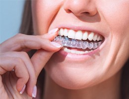 Woman smiling while putting clear aligner on top teeth