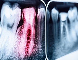 Dental x-rays with red highlighted tooth before root canal therapy