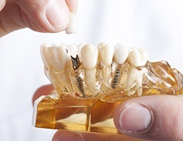 Model smile with implant supported dental crown