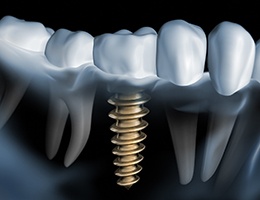 model of an X-ray of a patient with a dental implant 