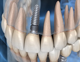 model of a dental implant in the upper jaw 