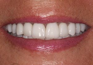 actual patient #5 with whitened smile