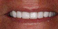 actual patient #15 bright, white smile after teeth whitening
