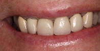 actual patient #15 yellowed smile before dental treatment