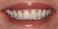 actual patient #10 healthy teeth and gums after porcelain veneers