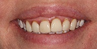 actual patient #10 red swollen gums before dental treatment