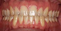 actual patient #11 perfectly aligned teeth after Invisalign