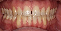 actual patient #11 gap between front teeth before dental treatment
