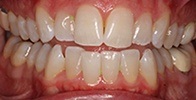 actual patient #12 crowded smile before Invisalign