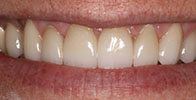 actual patient #14 healthy and white smile after dental treatment