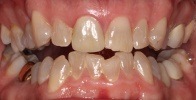 actual patient #6 decayed teeth before dental treatment