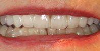 actual patient #7 healthy white smile after crowns & veneers