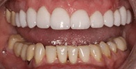 actual patient #3 Closeup of bright white teeth after treatment