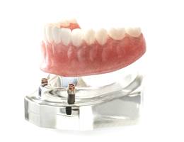 Model of implant dentures for lower arch
