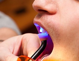 curing light being used to harden dental bonding