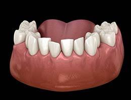 3D illustration showing crowded teeth before Invisalign