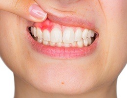 Closeup of diseased gums