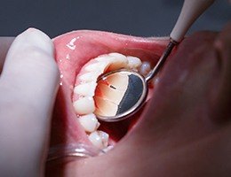 Closeup of smile during periodontal therapy