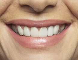 Flawless smile closeup after full mouth reconstruction
