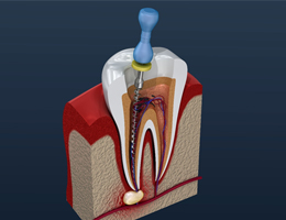 Animated root canal procedure