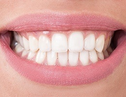 A woman at her dental appointment for fixed bridge tooth replacement