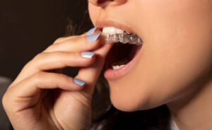 Close up of Invisalign over teeth